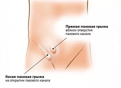 грыж1.png