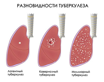 Лечение туберкулеза: