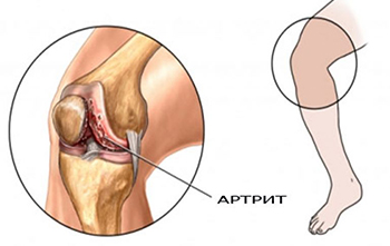 Ревматоидный артрит — причины, диагностика и лечение в Астрахани | Болезни | Клиника «Консилиум»