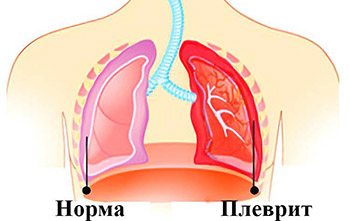 Плеврит