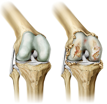 Лечение гонартроза (артроза коленного сустава) в Германии