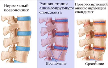 Спондилит – болезнь позвоночника | Блог ММЦ Клиника №1 Люблино, Москва