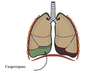 гидроторакс