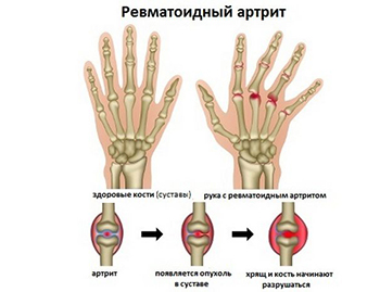 Лечение артрита мелких суставов кистей рук и стопы